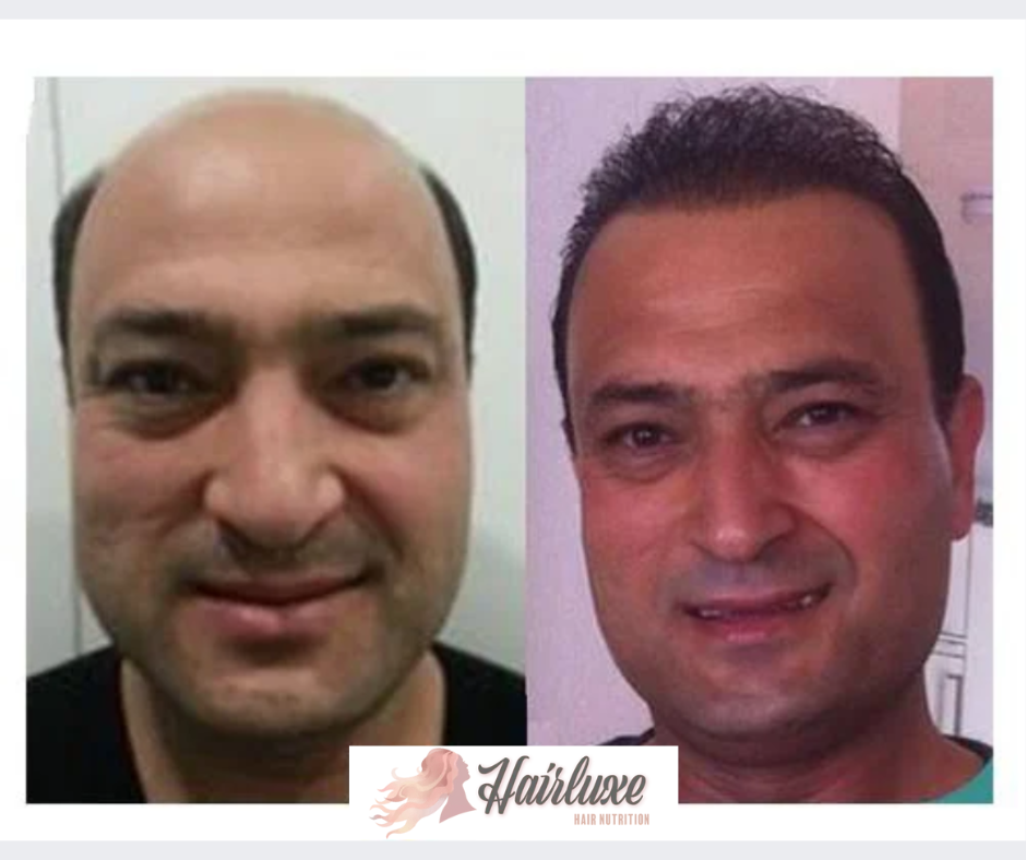 hariluxe-before-after hariluxe-before-after