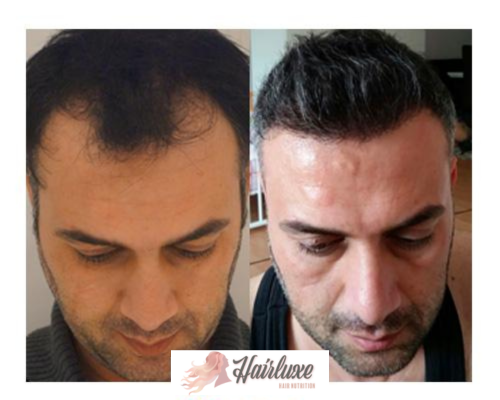 hariluxe-before-after2 hariluxe-before-after2
