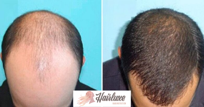 hariluxe-before-after3 hariluxe-before-after3