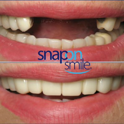 snap on smile img1