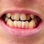 snap-on-smile-5.jpg snap-on-smile-5.jpg