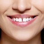 snap-on-smile-6.jpg snap-on-smile-6.jpg