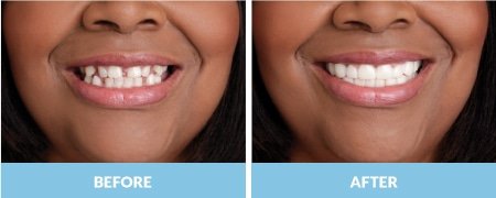 snap-on-smile4.jpg snap-on-smile4.jpg